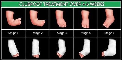 Mengenal Kaki Pengkor (Clubfoot) pada Anak: Penyebab, Gejala, dan Pengobatan
